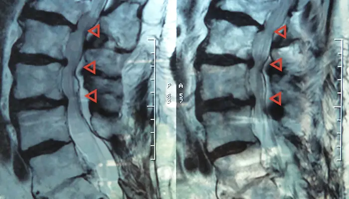 Featured image for “Spinal Stenosis is a common cause of low back pain and sciatica”