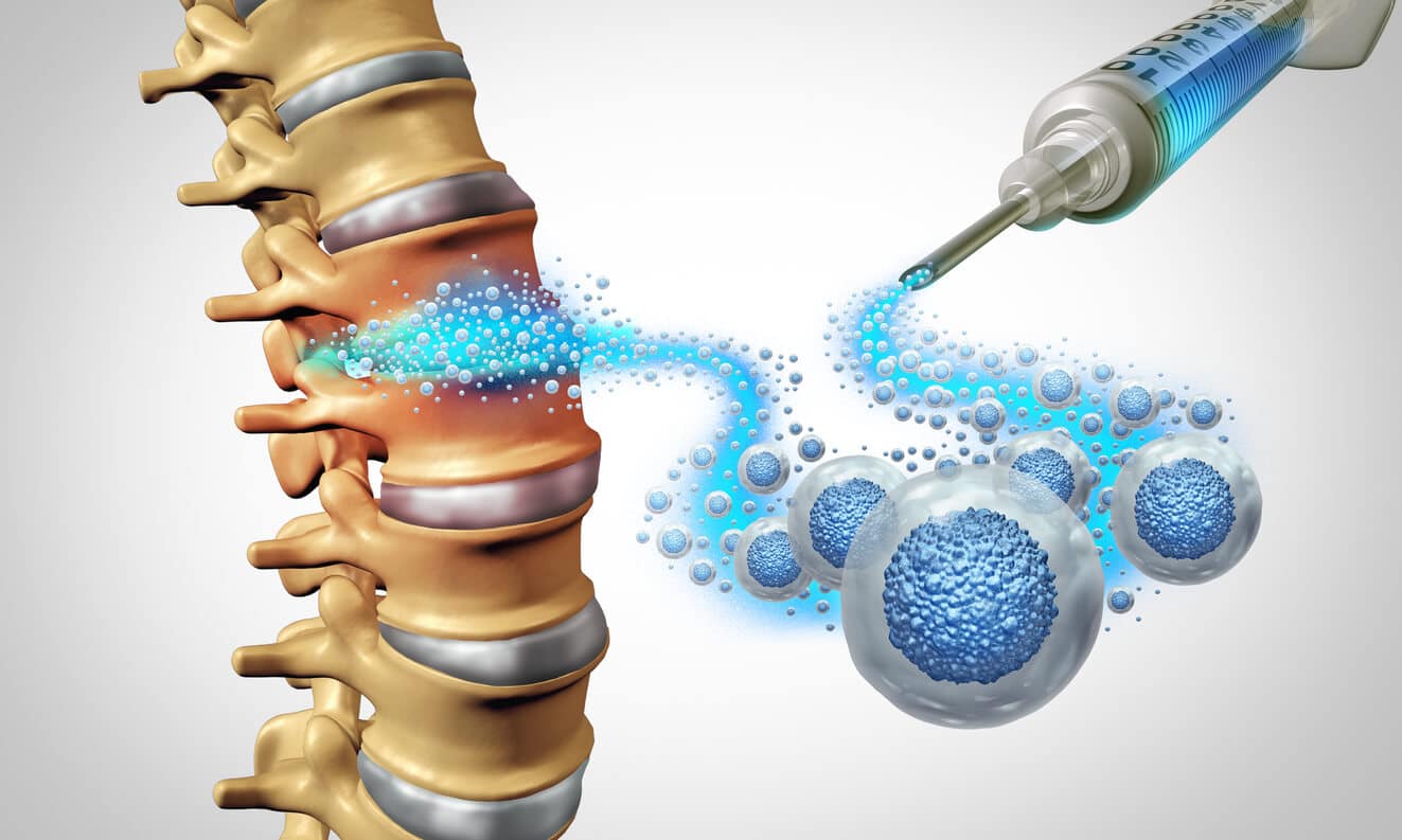Featured image for “Does Stem Cell Therapy and Lower Back Pain Mix?”